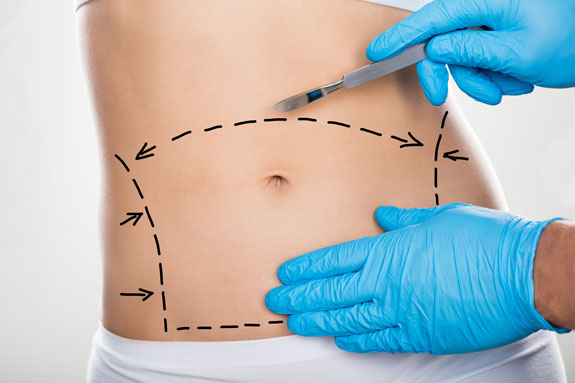 Abdominoplastik Jena